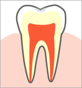 初期の虫歯(Co)