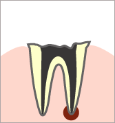 歯根に達する虫歯(C4)