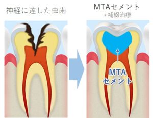 向ヶ丘遊園駅徒歩0分、登戸駅からも近い歯医者、近藤歯科で、MTAセメントで後悔するケースとは？適応症・成功率と、従来の治療との違いについて解説