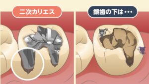 向ヶ丘遊園駅徒歩0分、登戸駅からも近い歯医者、近藤歯科で、神経を抜いた歯の寿命は何年？平均年数と寿命を延ばすための方法
