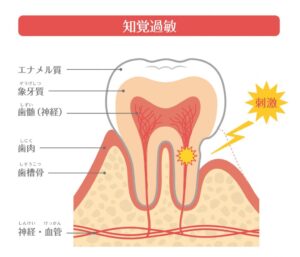 向ヶ丘遊園駅徒歩0分、登戸駅からも近い歯医者、近藤歯科で、冷たいものより熱いものがしみるのは危険信号？ 熱いものがしみるときに起きている口内トラブルを解説