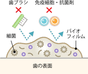 向ヶ丘遊園駅徒歩0分、登戸駅からも近い歯医者、近藤歯科で、奥歯の溝が黒いのは虫歯？小窩裂溝う蝕の見逃しリスクと予防方法を解説