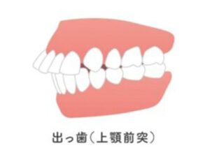向ヶ丘遊園駅徒歩0分、登戸駅からも近い歯医者、近藤歯科で、「口角」が上がりにくいのは歯並びのせい？口元の筋肉と噛み合わせの関係を解説